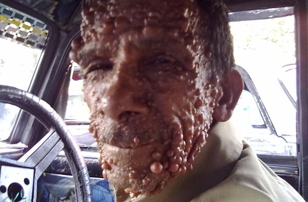 Bệnh u sợi thần kinh (Neurofibromatosis) là bệnh hệ thần kinh gây ra các khuyết tật da và các khối u trên các mô thần kinh. Tiến triển xấu theo thời gian và không có phương pháp điều trị đặc hiệu, phẫu thuật cắt bỏ không dứt điểm được bệnh. Những người mắc bệnh này rất hay bị xa lánh do đặc điểm xấu xí và ghê sợ.