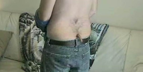 Bệnh mọc đuôi có thể do nứt đốt sống nhưng cũng có thể là một cá thể song sinh chưa hoàn thiện. Các thai nhi hấp thu dinh dưỡng trong tử cung, nhưng không phải tất cả thai nhi đều phát triển như dự đoán. Một khi thai khi không hấp thụ được chất dinh dưỡng nữa nó sẽ trở thành một cái đuôi. Chiếc đuôi đó bao gồm chất béo, cơ, dây thần kinh và các mạch máu mà không có bất kỳ xương hoặc sụn nào. Trên thế giới cũng có nhiều trường hợp mắc phải căn bệnh lạ này nhưng do ở chỗ kín và chẳng mấy ảnh hưởng nên cuộc sống của những người này chẳng có gì xáo trộn.