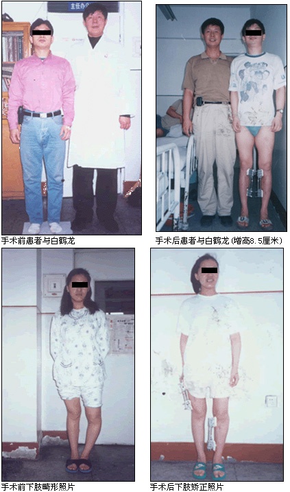 Ảnh thực các bệnh nhân thực hiện phẫu thuật nội soi tăng chiều cao.