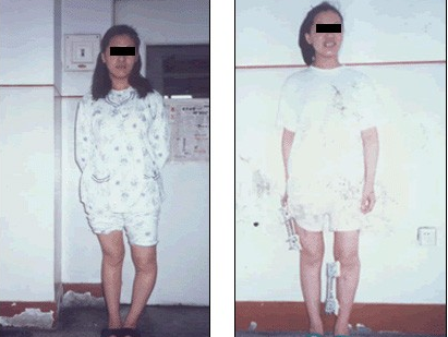Keo dai chan - phau thuat chi danh cho nguoi dung cam hinh anh