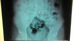 Ngu day, phat hien nieng rang lot vao bung hinh anh