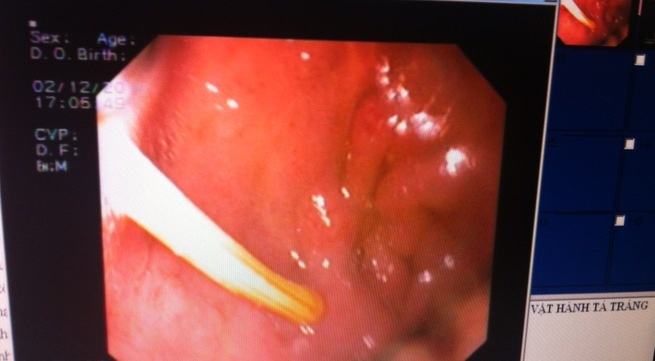 Nuot tam nhon tuong dau da day? hinh anh