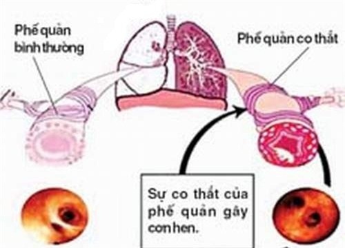 Hình ảnh co thắt phế quản trong bệnh cảnh hen.