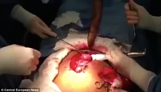 Mo lay ca song dai 1 m ra khoi bung nguoi dan ong hinh anh