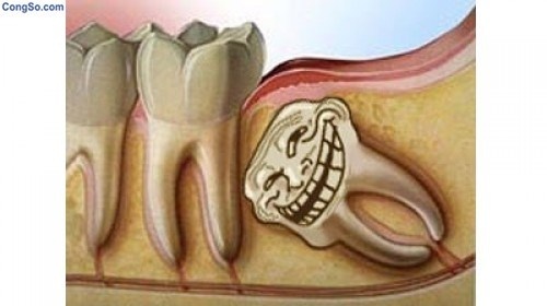 Người ta thường gọi “răng khôn” mọc dại.