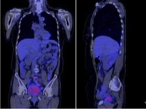 Ung thu di can, gia dinh xin ve van dieu tri thanh cong hinh anh