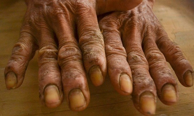 Nguoi bi phong to dia, phai nhung tay vao nuoc khi dau hinh anh