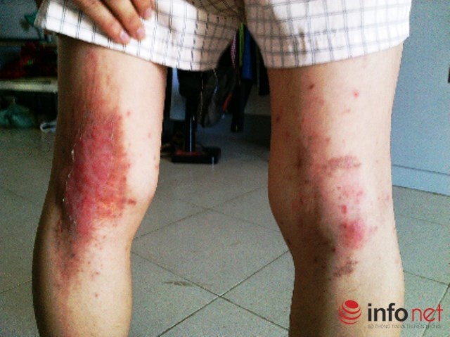 Hàng loạt SV Đại học HT bị kiến ba khoang tấn công gây thương tích khắp cơ thể.