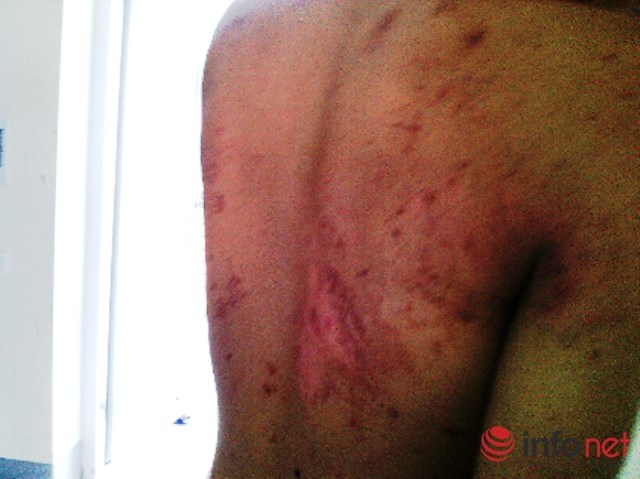 Kiến cắn sau lưng, vết thương lan rộng ra nhiều vị trí cơ thể.