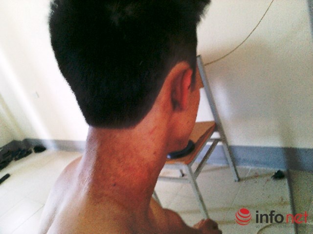 Vết thương nổi bọc nước và ửng đó gây ngứa ngáy và khó chịu.