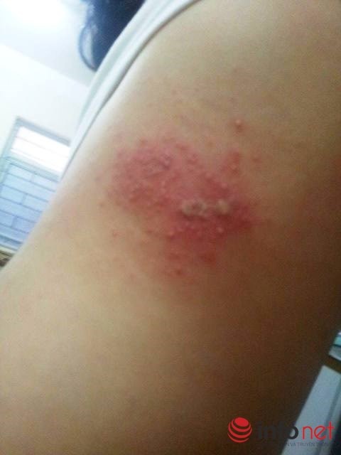 Vết thương nổi bọc nước và ửng đó gây ngứa ngáy và khó chịu.