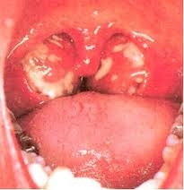 Viêm amiđan làm chít hẹp hầu họng gây ngáy ngủ.