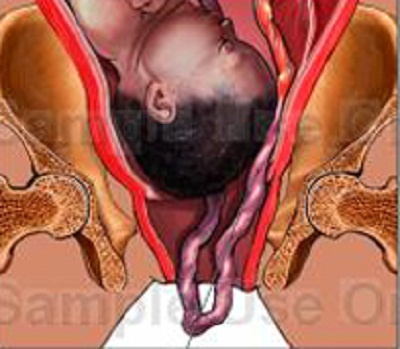 Sa dây rốn gây suy thai cấp do cuống rốn bị chèn ép giữa ngôi và thành chậu hông hoặc do bị sa ra ngoài âm đạo.