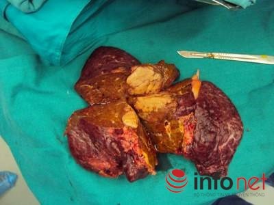 Hình ảnh gan bị xơ và ung thư tại BV Việt Đức.