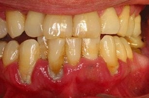 Phong va tri benh viem loi hinh anh