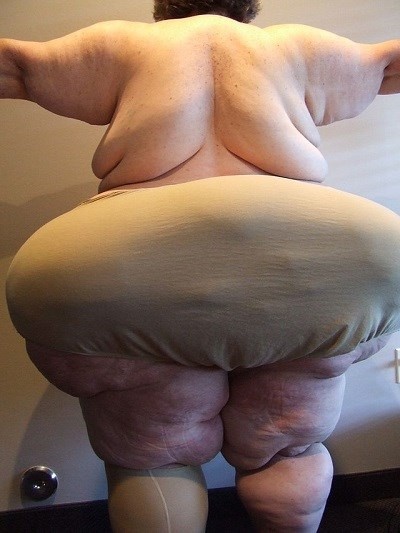 Bệnh nhân Lipedema ở thể nặng.