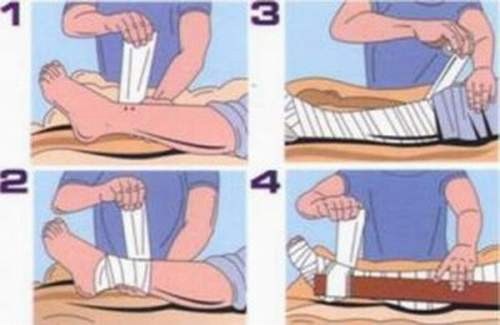 Đây là hình ảnh sơ cứu của ép bất động. Biện pháp này không được dùng khi bị rắn lục cắn.