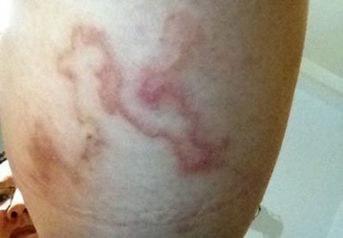 Hình ảnh ấu trùng giun dưới da.