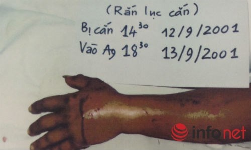 Chat dut ngon tay bi ran can, luc ghep lai van bi liet co hinh anh