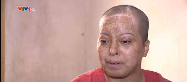 Mot minh chong choi can benh ung thu vu hinh anh