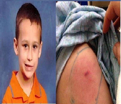 Bi nhen can, be 5 tuoi tu vong hinh anh