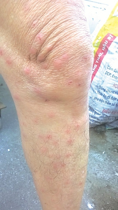 Chân của ông Đóa và tay anh Trung chi chít vết côn trùng cắn.