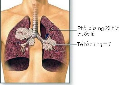 Uong ruou bia khien ung thu gan tang 60 lan hinh anh