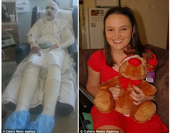 Toàn bộ cơ thể của Heron được quấn băng do miệng cô bị dính chặt và cô bị mất lớp da trên cùng trên mặt, ngực, lưng và cánh tay (ảnh trái). Cô đã sống sót kỳ diệu và giờ đang ở nhà phục hồi (phải). Ảnh: Daily mail.