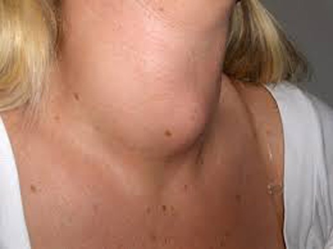 Xét nghiệm đo lượng hormon kích thích tuyến giáp (TSH) trong máu là cách tốt nhất để phát hiện vấn đề như suy giáp (tuyến giáp hoạt động kém), cường giáp (tuyến giáp hoạt động quá mức). Tuy nhiên, phương pháp chưa cho phép phát hiện các dấu hiệu tiền ung thư ở khu vực này.