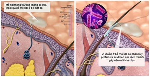 Vi khuẩn ở bề mặt da sẽ phân hủy protein và acid béo của dịch mồ hôi gây nên mùi khó chịu..