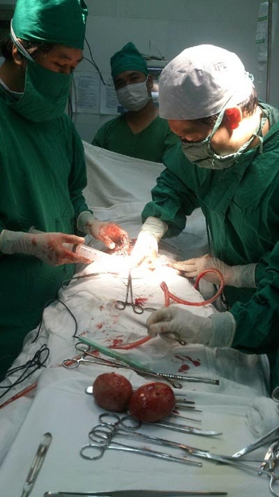 Hai viên sỏi thận lớn hơn 2 quả trứng.