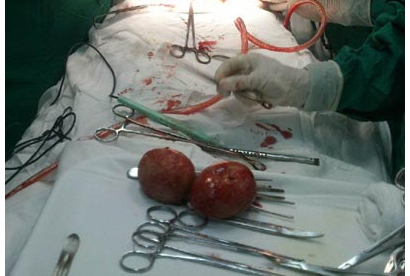 Boc 2 vien soi than nang gan 1 kg hinh anh