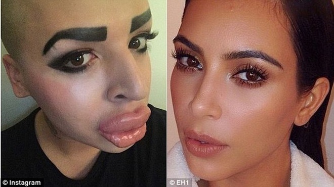 Chang trai bi bien dang vi co phau thuat cho giong co Kim hinh anh