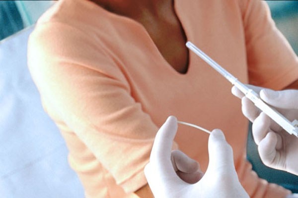 Biện pháp tránh thai này có thể kéo dài đến 3 năm. Tác dụng phụ thường gặp bao gồm chảy máu bất thường hoặc chảy những đốm máu đỏ. Một số phụ nữ mất hẳn kinh sau khi cấy. Phương pháp kiểm soát sinh đẻ tuyệt vời này dành cho tất cả mọi phụ nữ. Nó không vấn đề gì với những ai đang có bệnh, hút thuốc hay uống thuốc. Khả năng hiệu quả của nó chắc đến hơn 99%.