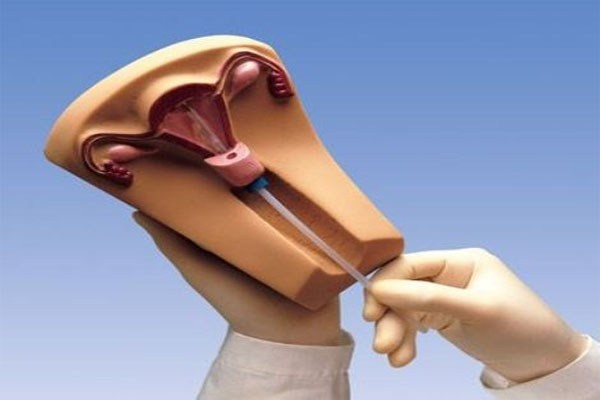 3. Vòng tránh thai nội tiết IUD. Thiết bị này hình chữ T được làm bằng nhựa hay đồng đặt bên trong tử cung của phụ nữ. Nó có tác dụng làm thay đổi môi trường bên trong, ngăn chặn tinh trùng gặp trứng hoặc thụ tinh với trứng. Vòng tránh thai này có lợi thế là có hiệu quả trong nhiều năm (5 năm), bạn hoàn toàn có thể có thai lại dễ dàng sau khi tháo vòng.