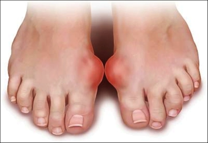 Bệnh gout: Các loại thức uống chứa chất cồn như rượu, bia, nội tạng động vật (óc, gan, bầu dục), hải sản (trừ cá), thịt, nấm, măng tây xuất hiện trong thực đơn các ngày lễ… vì dễ làm dư thừa axcid uric. Axit uric có thể kết tủa thành các tinh thể tích tụ trong bao hoạt dịch, ổ khớp gây đau đớn dữ dội cho cánh mày râu. 