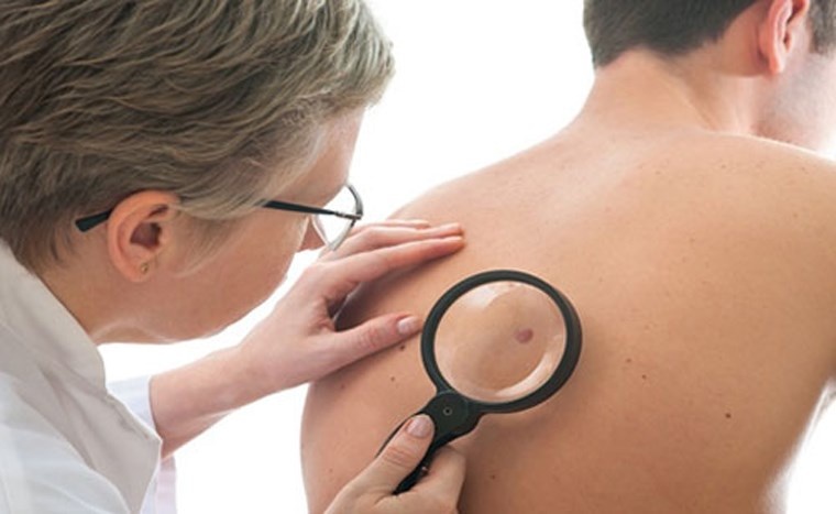 Bạn cũng dễ dàng phát hiện các khối u ác tính ở giai đoạn đầu khi thường xuyên tự kiểm tra, thăm khám bác sĩ. Đặc biệt, với nam giới, vị trí ngực và lưng là những nơi thường xuyên xuất hiện khối u da hơn cả.