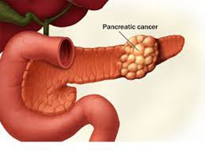 Ung thư tuyến tụy. So với các loại ung thư khác, ung thư tuyến tụy có tốc độ phát triển nhanh nhất. Căn bệnh khó có thể phát hiện sớm bởi hiện chưa có phương pháp chẩn bệnh hữu hiệu nào. Tỷ lệ sống của bệnh nhân ung thư tuyến tụy 1 năm đạt 25%. Sau năm năm, tỷ lệ này chỉ còn mức 6%.