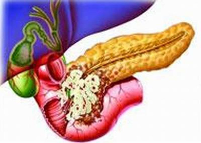 Để bảo vệ cơ thể mình, các bác sĩ khuyên nên duy trì chế độ ăn lành mạnh, thường xuyên tập luyện nhằm tránh chứng béo phì; bỏ thuốc lá càng sớm càng có lợi.