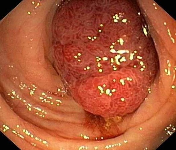 Ung thư đại tràng. Khoảng 49.400 trường hợp mắc mới mỗi năm. Bệnh là nguyên nhân gây nên cái chết của 27.000 người. Hầu hết các ca mắc ung thư đại tràng đều bắt nguồn từ những polyp không phải ung thư phát triển khoảng 10 – 15 năm trong niêm mạc đại, trực tràng.