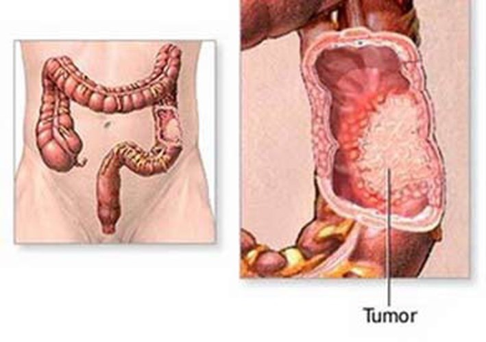 Theo Trung tâm Kiểm soát dịch bệnh Mỹ, tiến hành nội soi có thể giảm được 60% ca tử vong do căn bệnh. Việc nội soi nên tiến hành thường xuyên khi nam giới bước sang tuổi 50.