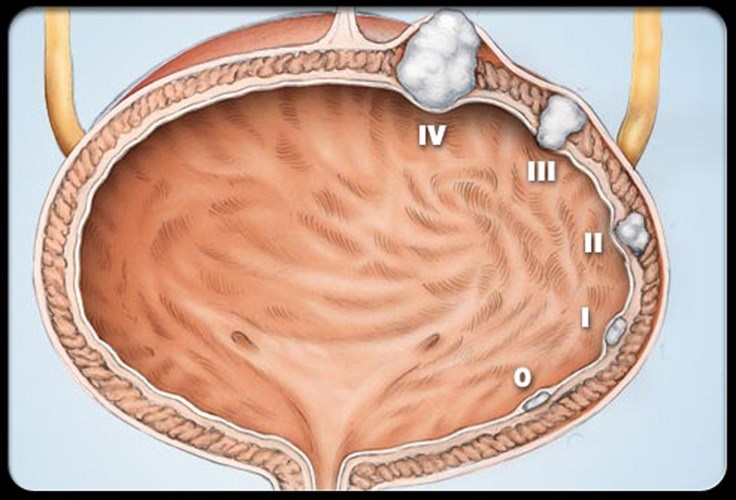 Ung thư bàng quang. Khoảng 52.000 trường hợp mắc mới mỗi năm. Bệnh là nguyên nhân gây nên cái chết của 10.400 người. Theo Viện Nghiên cứu Ung thư quốc gia Mỹ, giống như ung thư phổi, hút thuốc lá là yếu tố chính gây bệnh. So với phụ nữ, nam giới dễ mắc ung thư bàng quang cao hơn gấp 3 lần.