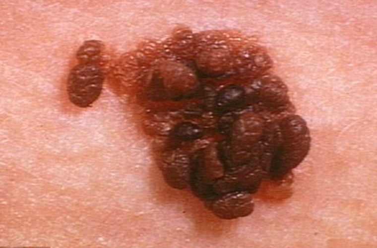 Ung thư da. Khoảng 38.800 trường hợp mắc mới mỗi năm. Bệnh là nguyên nhân gây nên cái chết của 5.600 người. Nhìn chung, các dạng ung thư da nguy hiểm nhất đều bắt nguồn từ việc tiếp xúc với tia cực tím. Do vậy để bảo vệ mình, nam giới nên tránh tiếp xúc với tia UV độc hại từ mặt trời.