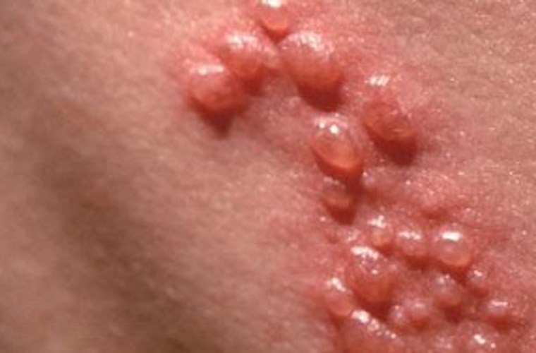 Mụn cóc ở cậu nhỏ. Các papillomavirus (HPV) có thể gây ra bệnh mụn trên dương vật. Mụn cóc rất dễ lây lan trong khi quan hệ không an toàn. Đó là những mụn cóc màu da, nổi trên da cậu nhỏ, bìu, xung quanh hậu môn...Có nhiều phương cách để chữa trị mụn cóc ở cậu nhỏ. Bạn nên đi khám da liễu hoặc nam khoa để khám kỹ càng xem có phải là mụn cóc hay là bệnh khác.