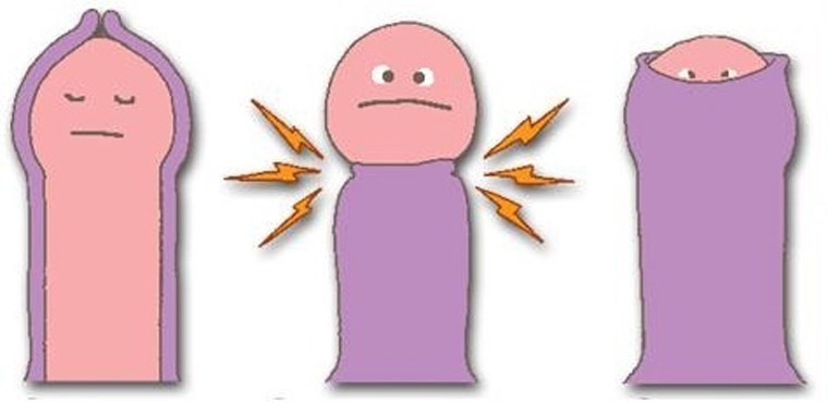 Chứng cong dương vật. Cong dương vật có thể do bẩm sinh từ khi sinh ra đã thế hoặc do chấn thương. Trường hợp cong quá 15 độ có thể yêu cầu phẫu thuật chỉnh sửa bởi khi ấy cậu nhỏ sẽ có hình dạng kì quặc.