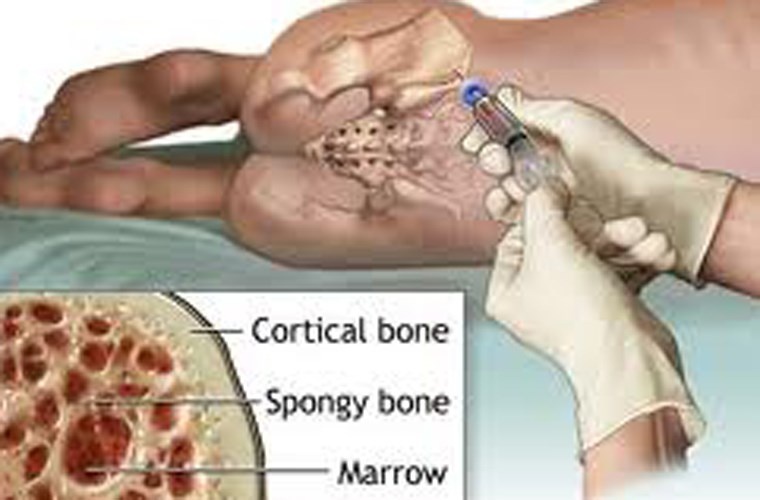 Bi quyet luyen tap tot nhat cho benh nhan suy tuy hinh anh