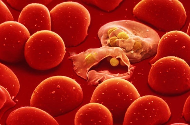 Đặc biệt, khi bị suy tủy, hầu hết bệnh nhân có triệu chứng thiếu máu dai dẳng, sốt nhẹ, xuất huyết da niêm mạc… Vì lý do này, không ít người từ chối vận động bởi lo ngại các bài tập dễ khiến họ cảm thấy mệt mỏi, mất sức hơn.