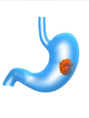 Giống như nhiều loại ung thư khác, việc phát hiện sớm góp phần đáng kể trong việc nâng cao hiệu quả quá trình điều trị. Tùy từng giai đoạn, bệnh có biểu hiện khác nhau. Chính vì lý do này, không nên bỏ qua bất kỳ dấu hiệu bất thường nào của cơ thể.