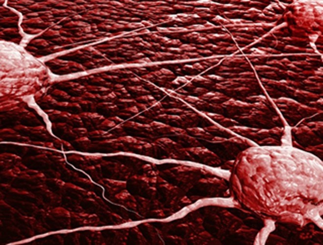 Sang giai đoạn 3, tế bào ung thư tiếp tục lan đến các cơ, lan ra 7 đến 15 hạch bạch huyết, ảnh hưởng đến lá lách và gan.