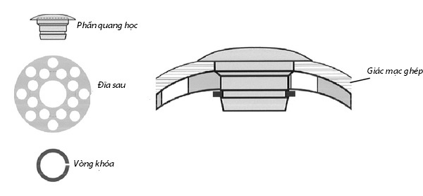 Cấu tạo của giác mạc Keratoprosthesis.